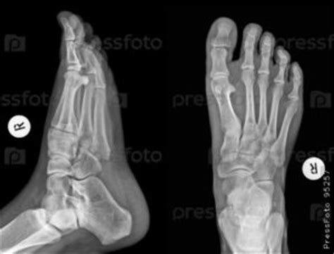 ayak röntgeni nasıl çekilir